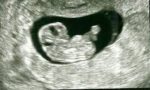 8 Weeks ultrasound